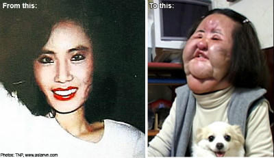 Nhiều bài học "xương máu" từ phẫu thuật thẩm mỹ